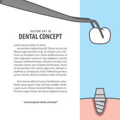 Layout Implant cartoon style for info or book illustration vector on blue background. Dental concept.
