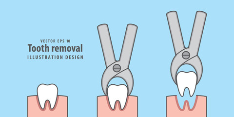 Tooth removal illustration vector on blue background. Dental concept.