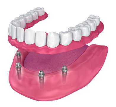 Overdenture to be seated on implants - ball attachments. 3D illustration