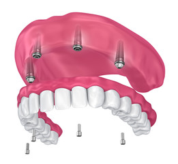 Overdenture to be seated on implants attachments. 3D illustration