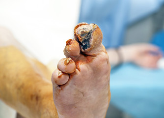 Diabetic foot syndrome. Gangrene of the big toe. General view