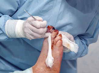 Diabetic foot syndrome. Gangrene of the big toe. Amputation of the big toe. Stage 1 - incision