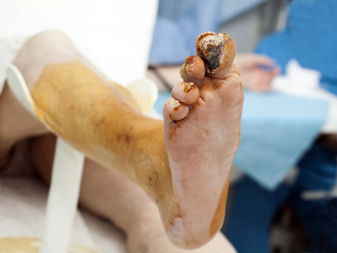 Diabetic foot syndrome. Gangrene of the big toe. General view