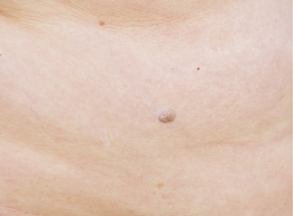 Fototapeta premium mole on human skin