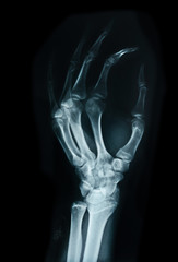 Carpal bones Human X Ray.