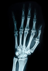 Hand x-ray view.
