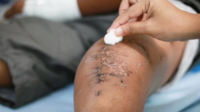 Hand of woman using cotton to cleaning  surgery wound broken bone knee of the man
