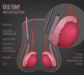 Man vasectomy image