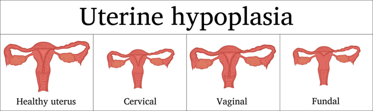 Illustration of Uterine hypoplasia