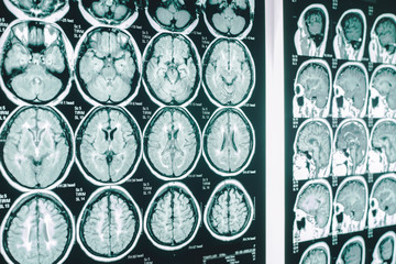 brain  on film  MRI