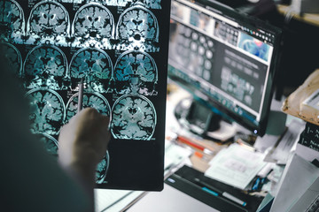 alzheimer's disease on MRI - obrazy, fototapety, plakaty