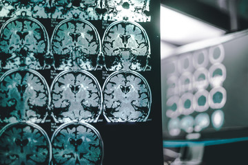 alzheimer's disease on MRI