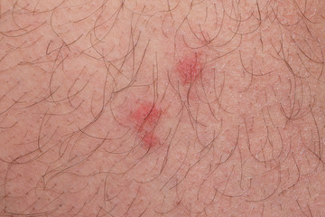 closeup of redness over caucasian skin