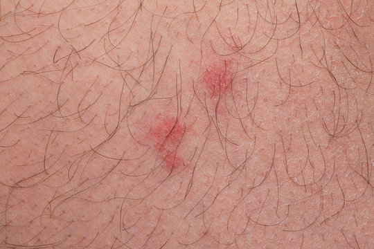 Flohbisse Bilder Durchsuchen 2,853 Archivfotos, und