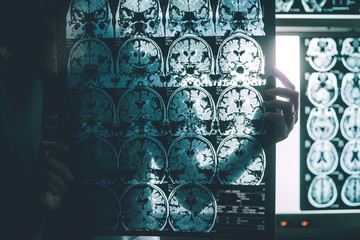 Alzheimer's disease on MRI film 