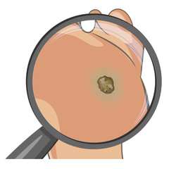 Foot wart magnified with glass. Foot bottom pathology: verruca, wart, papilloma virus. Male or female sole, barefoot. Cartoon style, hand drawn. Vector illustration isolated on white.