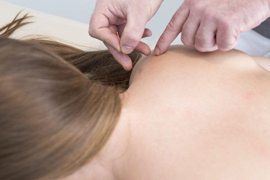 Female patient receiving acupuncture