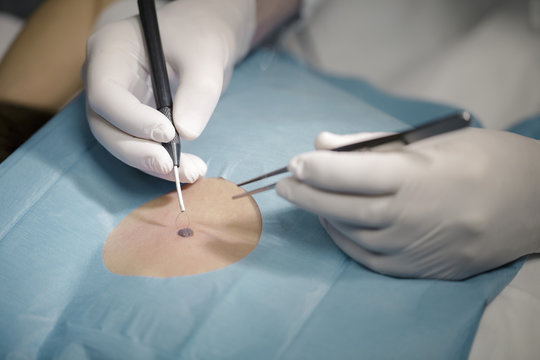Dermatologist removes mole, close-up