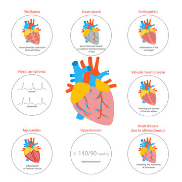 Cartoon Heart Disease Infographic Card or Poster. Vector
