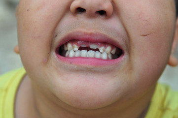 view of an  Asian boy with broken teeth