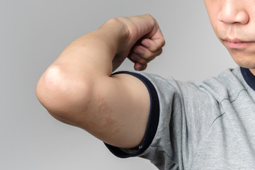 Fototapeta premium Allergy rash