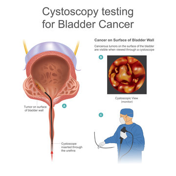 Bladder cancer is any of several types of cancer arising from the tissues of the urinary bladder. Info graphic vector.