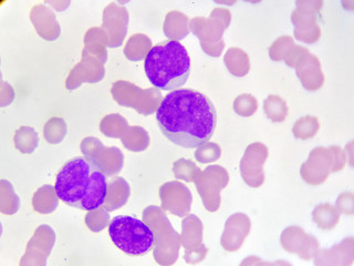Blood picture of acute myeloid leukemia (AML) cells, analyze by microscope

