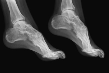 R&ouml;ntgenbild F&uuml;sse