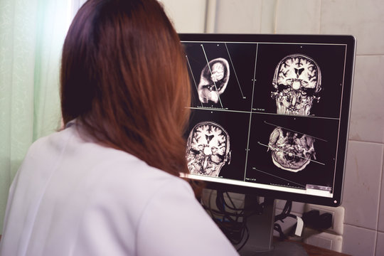 MRI brain of Dementia patient Hippocampal atrophy grade 4 by MTA scale Temporal atrophy