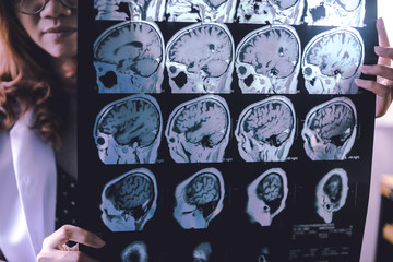 frontal lobe atrophy on MRI film probably Frontotemporal Dementia - obrazy, fototapety, plakaty