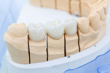 Detailaufnahme eines Prothesensattels mit Zahnersatz im Zahnlabor