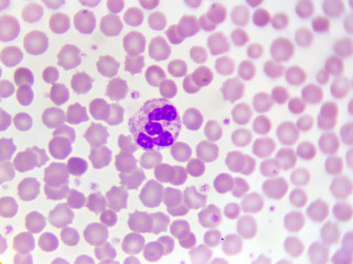 Neutrophil cell (white blood cell) in blood smear, analyze by microscope
