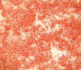 Blood smear under microscope present neutrophils and red blood cells. Photo micro sections with high magnification with light microscope