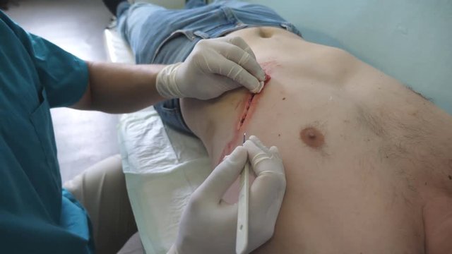 Hands of male doctor disinfects and stop the blood, after incision scalpel. Close up