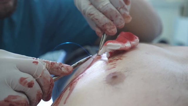 Arms of doctor in gloves sewing wound. Wound suturing by surgeon. Close up