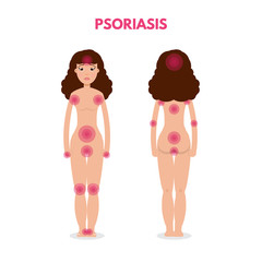 Areas of the body Psoriasis. Woman nude character. Vector illustration.