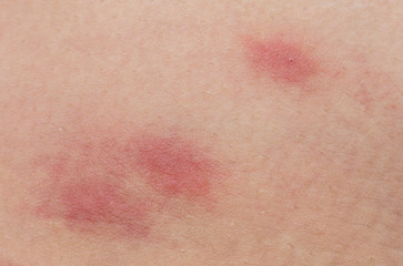closeup of flea bites