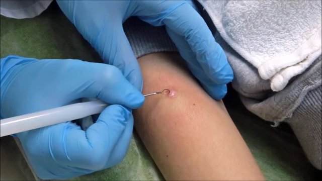 Dermatologist surgeon removes scar skin in patient arm with electro scalpel
