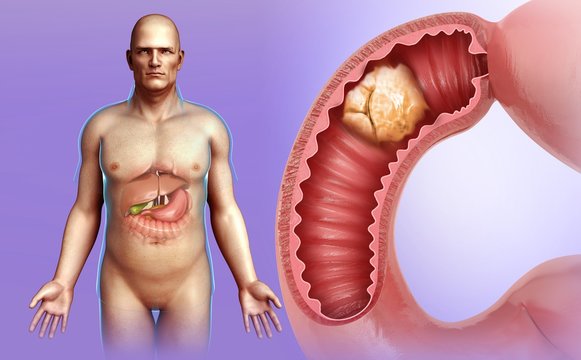 Man with intestinal cancer, illustration