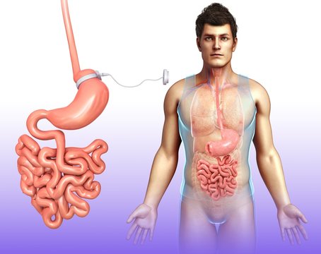 Adjustable Gastric Band, Illustration