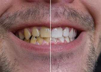 Teeth whitening concept. Smiling man with yellow teeth - before and after.