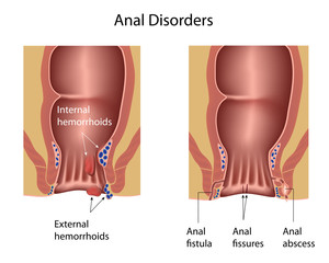 Anal disorders: hemorrhoids, fistula, fissures, abscess 