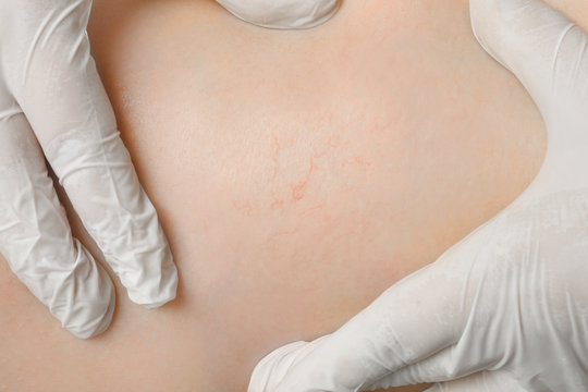 Doctor Examining Woman's Leg For Varicosis, Closeup