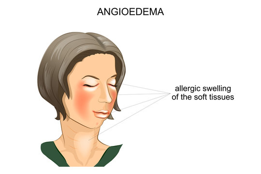 Angioedema. Allergic Swelling