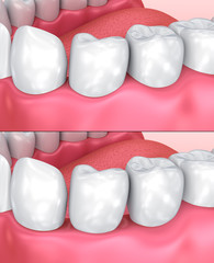 Normal and lowered gum. Medically accurate tooth 3D illustration