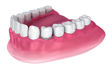Removable partial denture. Medically accurate 3D illustration