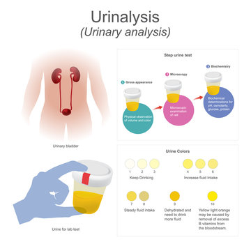 Urinalysis (urinary analysis) The lab test dips the strip into urine, chemical reactions change the colors.