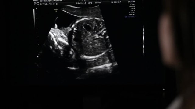 the ultrasound picture on the computer screen