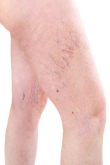 legs with spider varicose veins mole