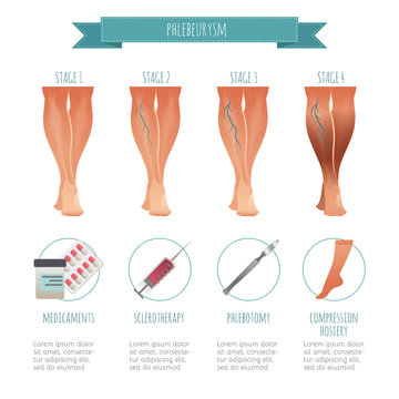 Phlebology infographic, treating varicose veins. Vector illustration of stage of vein diseases. Medical compression hosiery